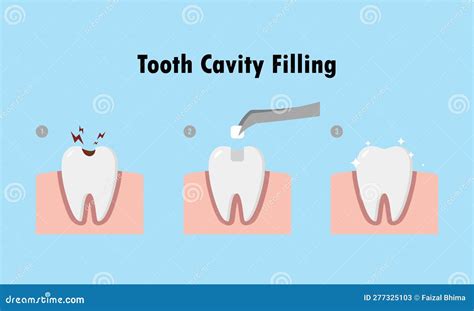 Step of Restoring Tooth Cavity Filling Stock Vector - Illustration of protection, biology: 277325103