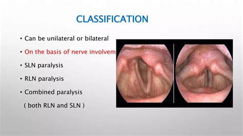 Vocal cord paralysis | PPTX