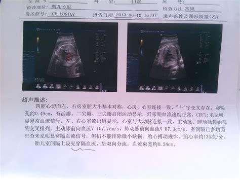 怀孕28周去医院做超声筛查，发现胎儿心脏室间隔有2.4mm的间隔，肠管13mm - 百度宝宝知道