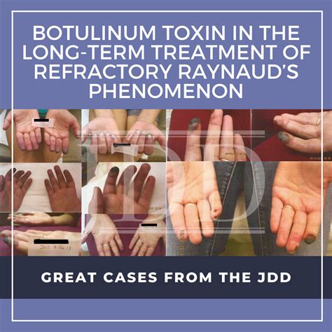 Botulinum Toxin in the Long-Term Treatment of Refractory Raynaud’s Phenomenon - Next Steps in ...