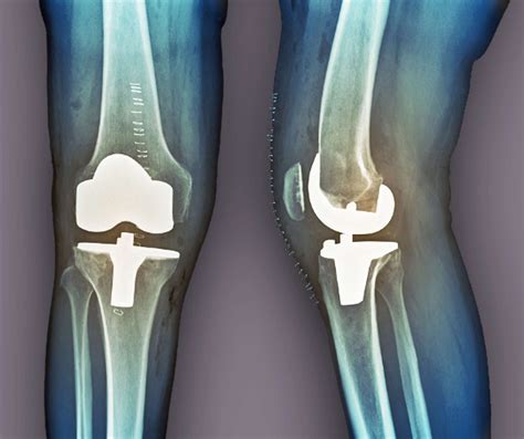 Partial vs. Total Knee Replacement Surgery