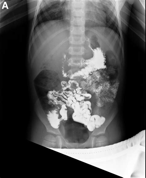 Meckel’s Diverticulum on Small-Bowel Follow-Through Series and ...