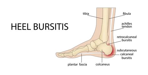Lump on Achilles Tendon: Causes, Symptoms, and Recommended Podiatry Treatments
