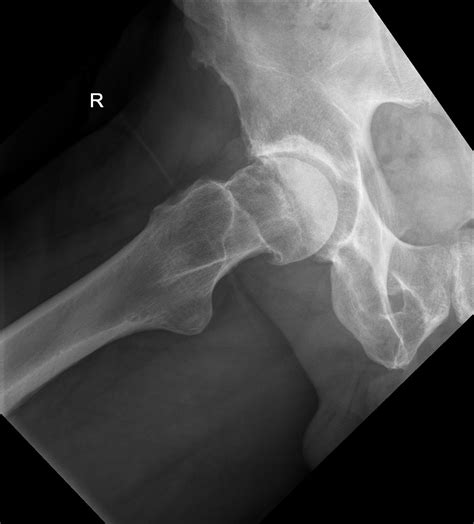 Cam-Type Femoroacetabular Impingement Morphology at James Goldsbrough blog