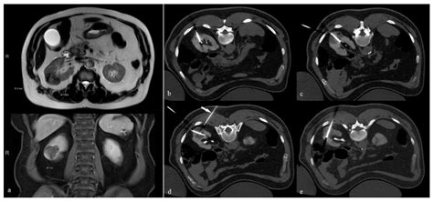 CT colonography feasible than DNA stool testing in colorectal cancer ...