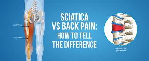 Sciatica vs Back Pain – Symptoms, Causes & Key Differences