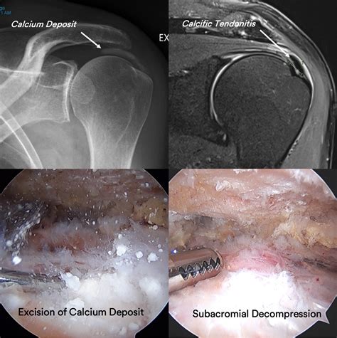 Shoulder Calcification