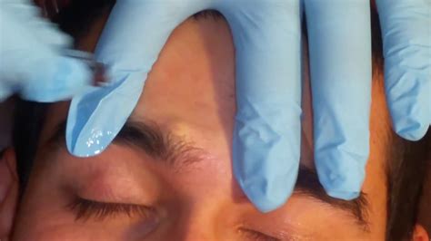 Image result for Loud Exploding Zit