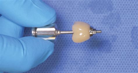 Ti-Base implant cementation technique