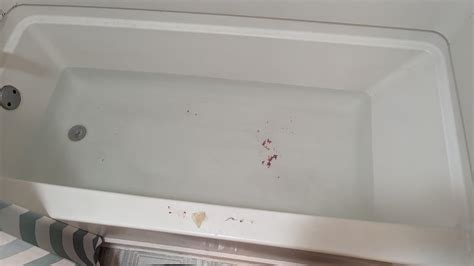 Pilonidal Cyst became infected and painful last week. Popped yesterday. This is just squeezing ...