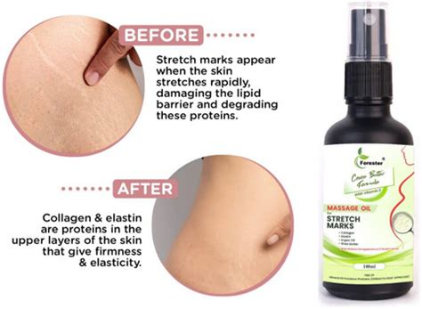 forester Present Repair Stretch Marks Removal-Natural Pregnancy Breast ...