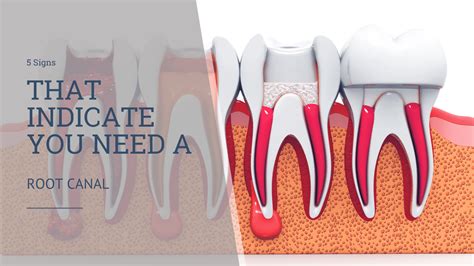 Root canal signs Archives - Eastern Idaho Endodontics