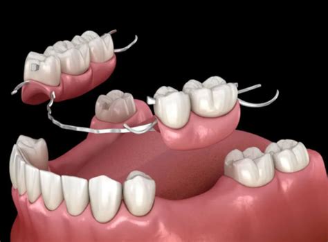 Image result for Bottom Front Teeth Partials