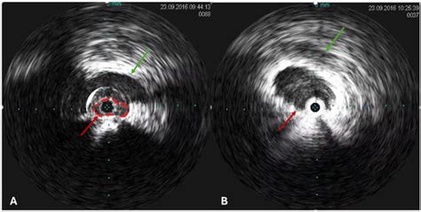 Management of Extra-Pelvic Varicose Veins of Pelvic Origin in Female ...