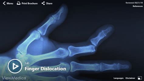 Image result for Finger Dislocation Reduction