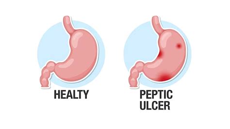 Are Ulcers Caused by Stress? – NutritionFact.in