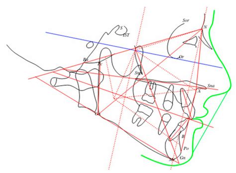 Ectopic Eruption of the First Permanent Molar in the Maxilla ...
