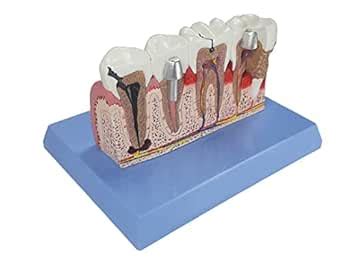ZX | Teeth Pathologies Model | PVC | Anatomical Model : Amazon.in ...