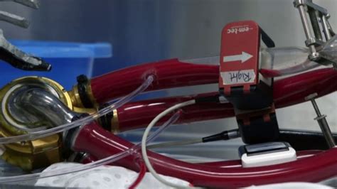 ‘Groundbreaking,’ First-in-human total artificial heart implanted ...