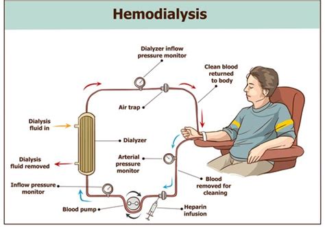 Image result for Dialysis Procedure Step by Step