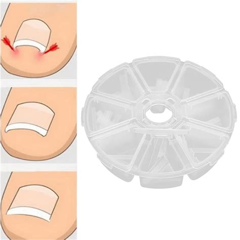 Buy 120pcs Ingrown Toenail Corrector Strips,Professional Paronychia ...