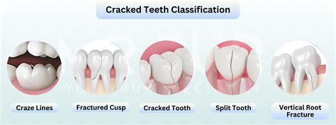 Addressing Cracked Teeth with Endodontic Treatment: A Comprehensive Guide – Mr Bur
