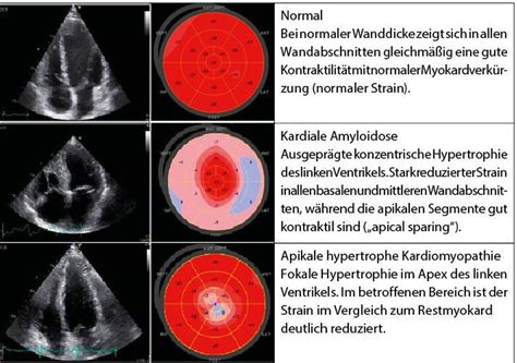 Echokardiografische Beurteilung der Linksventrikelhypertrophie ...