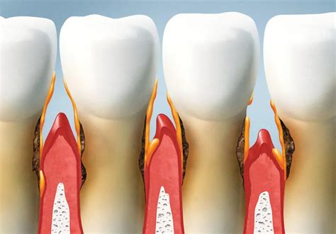 牙齿用手掰有轻微晃动，牙齿松动的三个程度，部分松动牙可恢复_深圳爱康健口腔医院官网