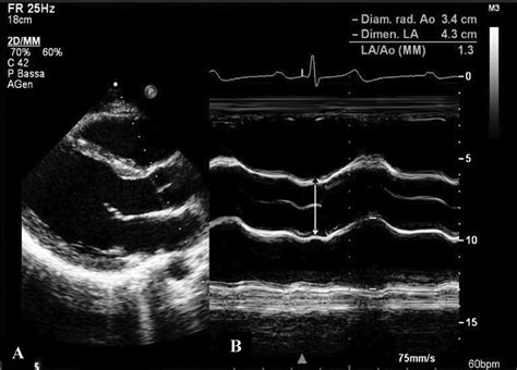 Prevalence and Clinical Significance of Aortic Root Dilation in Highly ...
