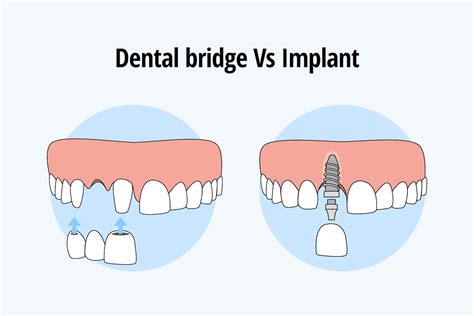 Dental Bridges Vs. Implants, Cost & Benefits | Crofton Dental Care