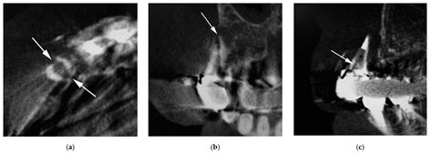 Diagnosis of Vertical Root Fractures in Endodontically Treated Teeth by ...
