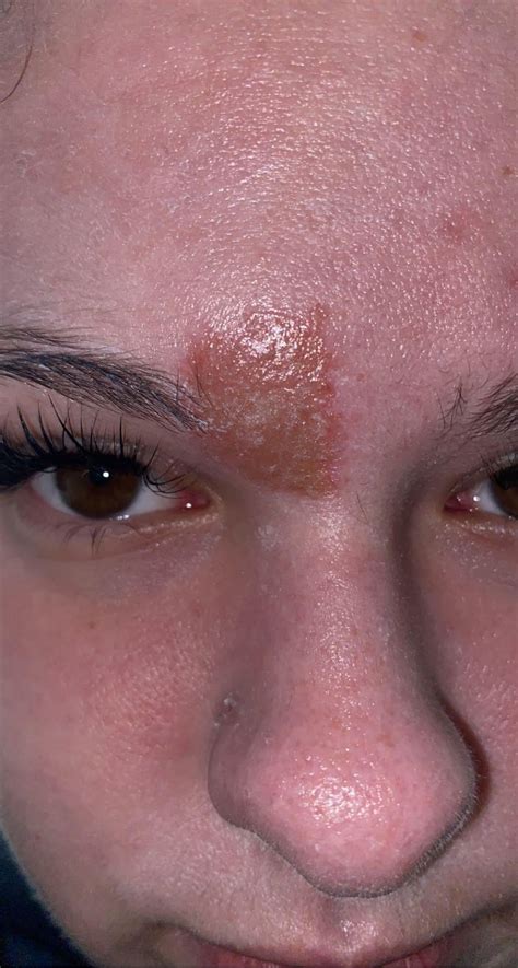 Image result for Blood Red Pimple