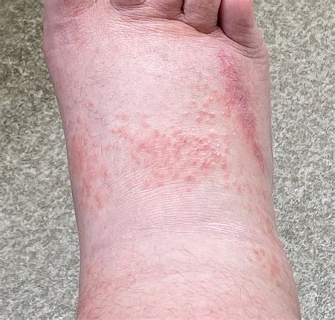 Collection 94+ Pictures What Is This Rash On My Foot Full HD, 2k, 4k