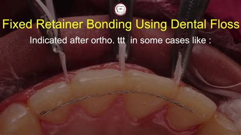 Image result for Floss Threader Fixed Retainer