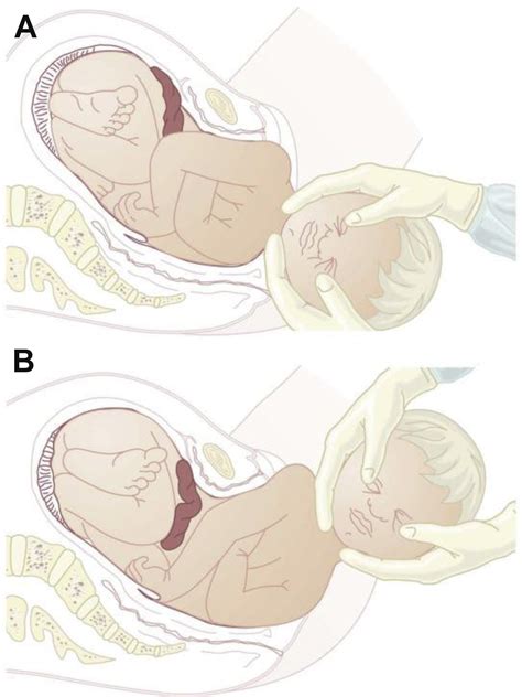 Precipitous Labor Delivery