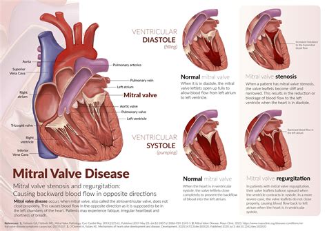 Medical illustration: Mitral valve disease :: Behance