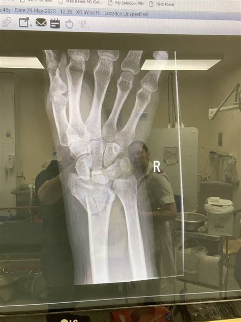 Image result for Distal Radius Fracture Recovery