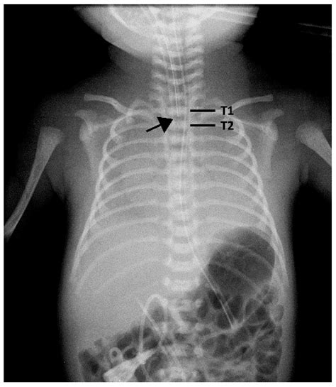 Weight Is More Accurate than Gestational Age When Estimating the ...