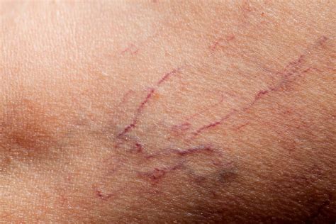 How to Erase (And Prevent) Broken Capillaries | The Healthy