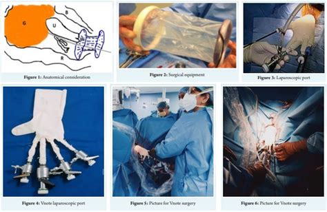 V Notes Procedure 的图像结果