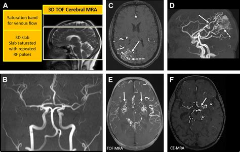 Non-Contrast Magnetic Resonance Angiography: Techniques, Principles, and Applications - Magnetic ...