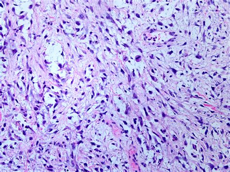 Spindle Cell Carcinoma Pathology Outlines at Joseph Sauls blog