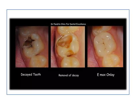 Image result for Difference Between Direct and Indirect Pulp Capping