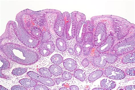 Tubular Adenoma Of Colon
