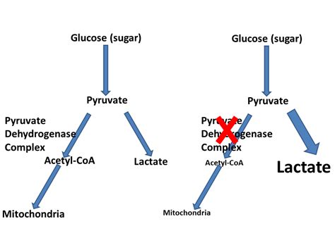 Image result for Pyruvate Dehydrogenase Complex Deficiency