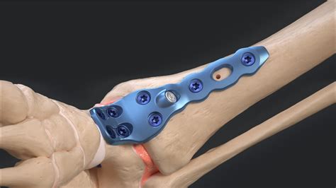 Compression Plate Ankle 的图像结果