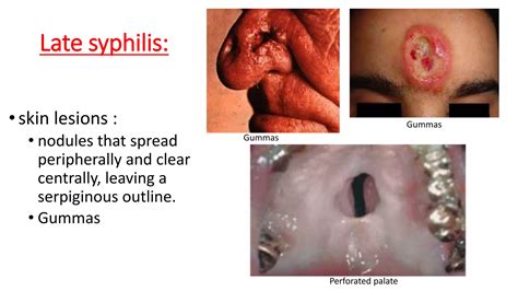 10th lecture syphilis | PPTX