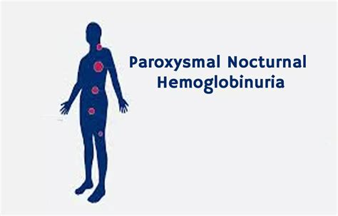 Pegcetacoplan superior to eculizumab for paroxysmal nocturnal ...