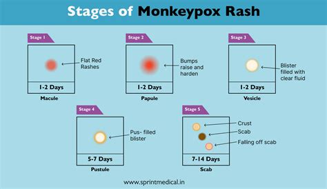 Chickenpox Stages