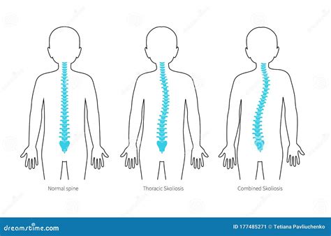 Scoliosis In Children Vector Illustration | CartoonDealer.com #155253264